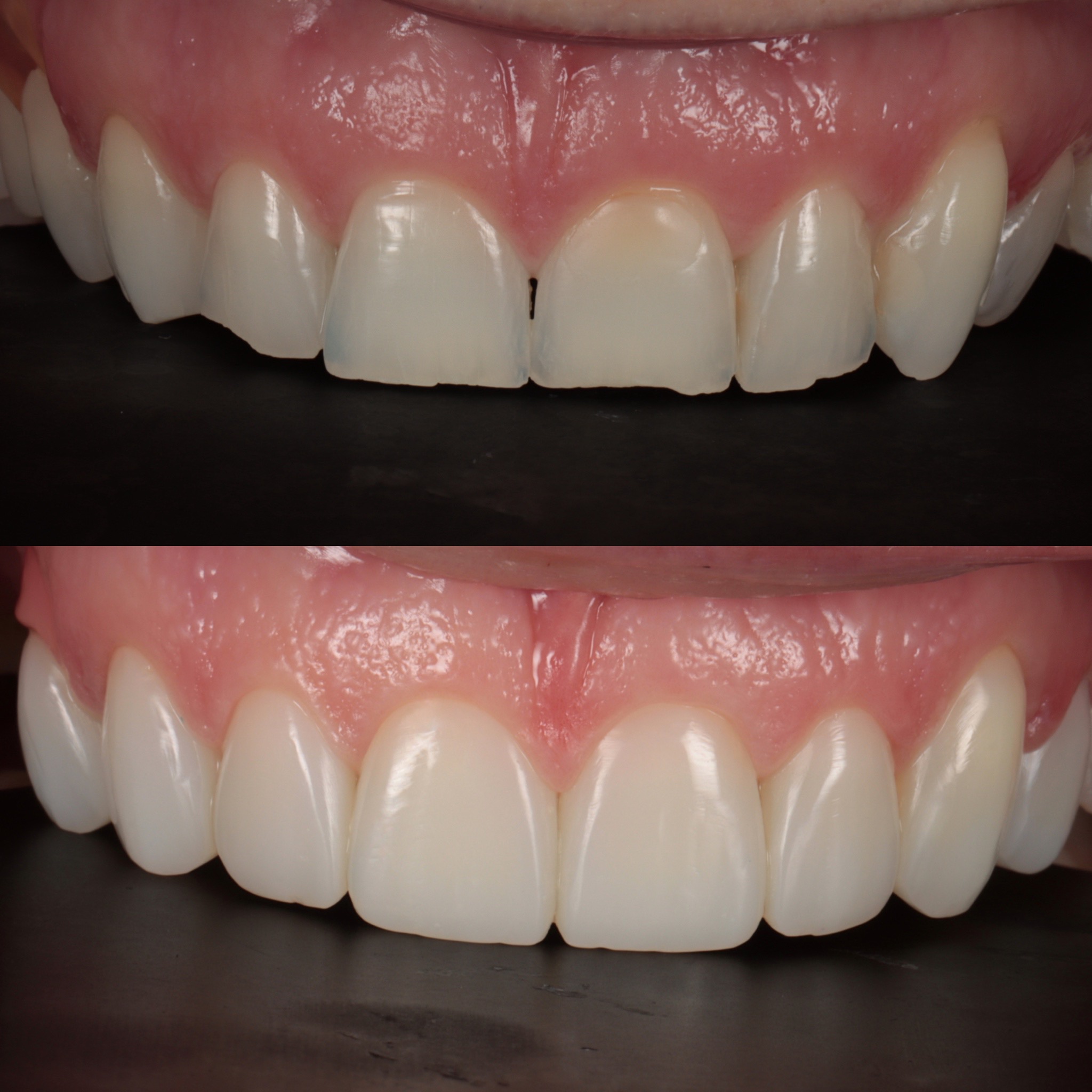 Before Casework — inconsistent dental case photo