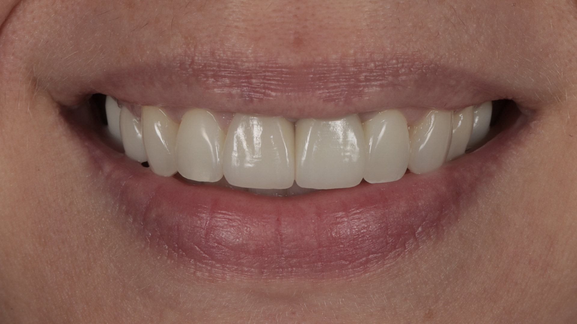 Story 2 — after photo