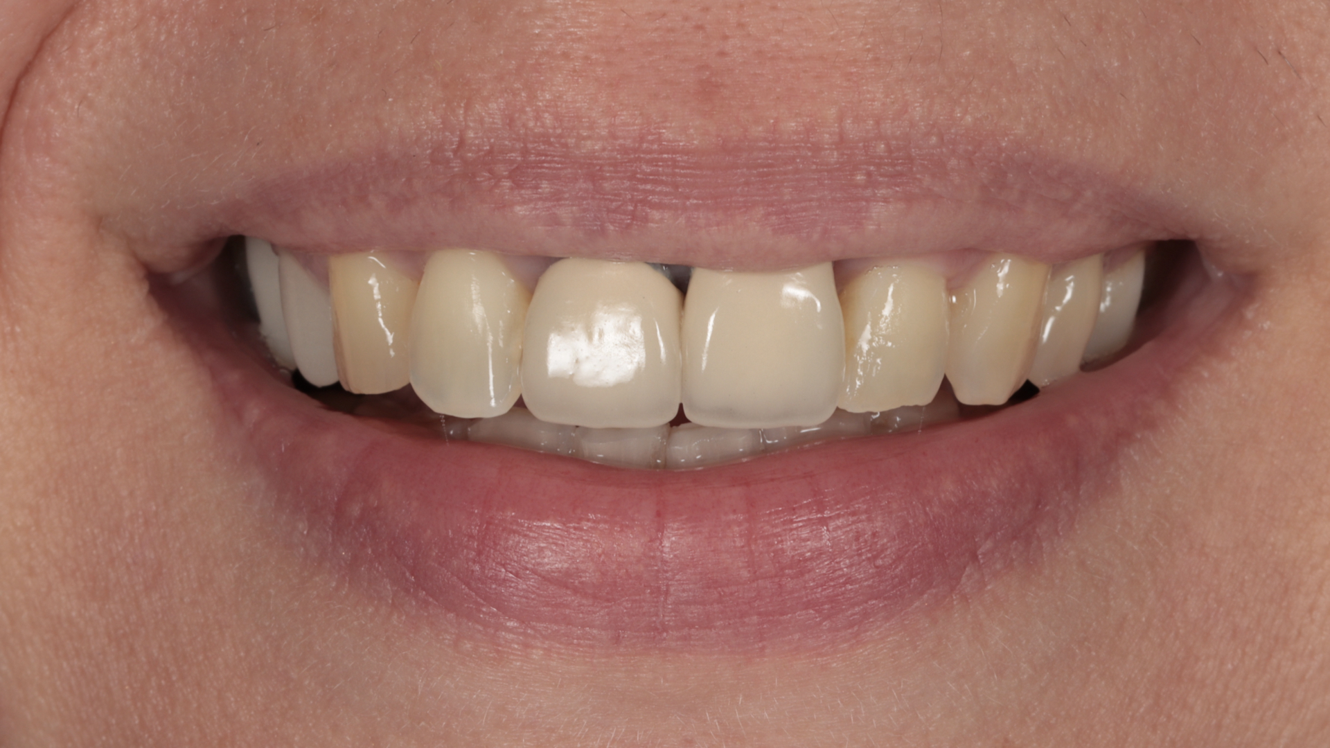 Story 1 — before photo